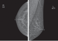 Photo Leasing BEMEMS Pinkview-DR PLUS Mammographe - 3